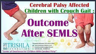 Cerebral Palsy Affected Children with Crouch Gait  Outcome After SEMLS  Trishla Foundation [upl. by Woodrow527]