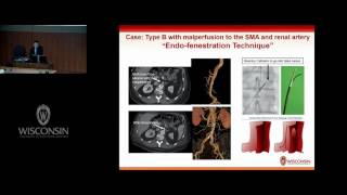 IDE Trial for Fenestrated Thoracic Arch Stent Graft [upl. by Treb46]