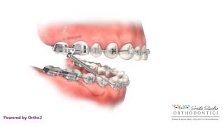 Forsus  Orthodontic Appliance [upl. by Netsuj]