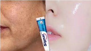 Utilisez du dentifrice pour éliminer la pigmentation et le mélasma et blanchir la peau [upl. by Anirroc713]