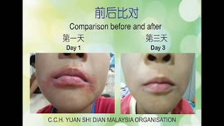 嘴巴红肿发痒案例 马来西亚 Mouth Redness and Swelling Case Malaysia [upl. by Nyraf306]