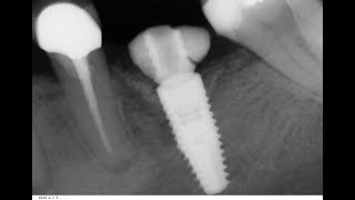 Comp Guided immediate implant placementimmediate fabricated abtfinal restoration A full case [upl. by Frame845]