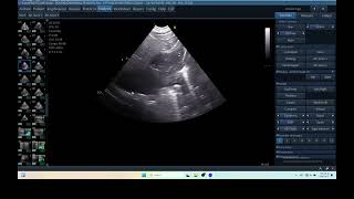 IQ 290 TFAST LUNG MASS ULTRASOUND ICP CPP ECHOPAC ANALYSIS 00 [upl. by Morgenthaler]