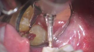 operculectomy of mx 3dr molar [upl. by Ordway]