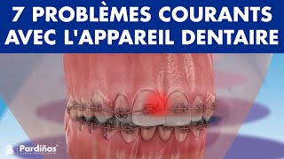 Urgence orthodontique  7 PROBLÈMES courants avec lAPPAREIL dentaire © [upl. by Berghoff236]