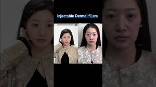 injectable Dermal fillers beautytransformed facetransformation [upl. by Carola]