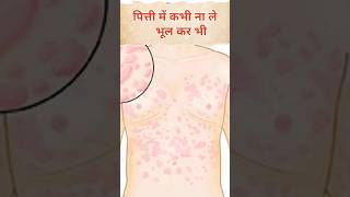 😱 ठीक नही होगी पित्ती  पित्ती में क्या ना खाए  Urticaria shorts [upl. by Llerrud]