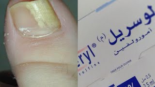 فطريات الأظافر  الأسباب و العلاج Mycose des ongles 💅 اصفرار الأظافر [upl. by Redyr]