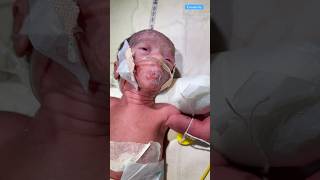 Very Sick Newborn medical viralvideo [upl. by Einehpets]