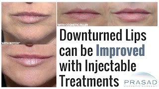 How a quotPermafrownquot or Downturned Lips can be Treated with Botox® or Cosmetic Fillers [upl. by Ikkir]