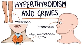 Understanding Hyperthyroidism and Graves Disease [upl. by Yldarb]