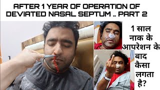 Deviated Septum Surgery  DNS  Septoplasty amp Turbinoplasty  Septoplasty Vlog In Hindi Part 2 [upl. by Whit679]