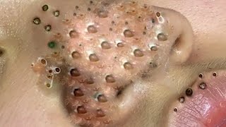 Big Cystic Acne Blackheads Extraction Blackheads amp Milia Whiteheads Removal Pimple Popping  1097 [upl. by Ladew]