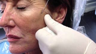 NonSurgical Face ThreadLift Procedure [upl. by Esiocnarf]