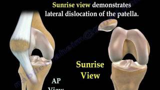 Patellar Dislocations  Everything You Need To Know  Dr Nabil Ebraheim [upl. by Assirrem274]