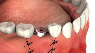 SIC invent Dental Implant Guideline for patients Abutment Single Tooth [upl. by Itsrejk]