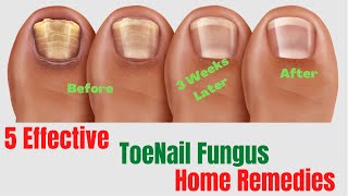 5 Natural Remedies For Toenail Fungus – Toenail Fungus Treatment At Home [upl. by Aloeda179]