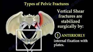 Pelvic Fracture Overview  Everything You Need To Know  Dr Nabil Ebraheim [upl. by Spanos436]