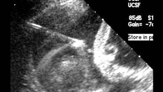 UCSF Radiology Ultrasound of a Fetal Hydrothorax Drainage [upl. by Orv595]