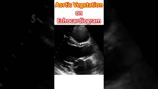 Aortic Vegetation on Echocardiogram [upl. by Akiem571]