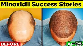 what is minoxidil  can minoxidil regrowth your hair detailed video on minoxidil [upl. by Myrtia662]