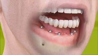 Straumann  Fixed restoration with 46 implants all straight [upl. by Klusek]