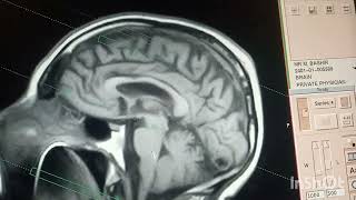 How to perform MRI Brain Planning And protocol for MRI brain Sequences for MRI brain Open magnet [upl. by Chipman265]