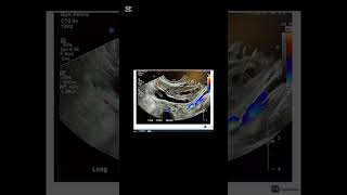 Normal vs abnormal appendix ultrasound Appendicitis [upl. by Noivax]