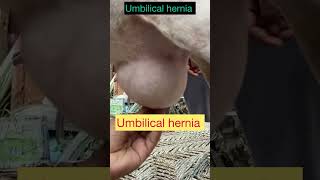 Umbilical hernia l Dr Umar Khan [upl. by Ylloj712]