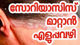 Psoriasis Treatment in Ayurveda Malayalam  Psoriasis Treatment at Home in Malayalam [upl. by Nady]