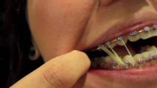 Braces Update  12 double elastics [upl. by Alford]