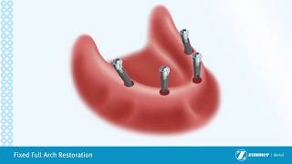 Implant Supported Denture [upl. by Lleznod]