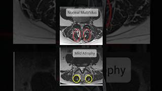 How to check Multifidus muscle in MRI [upl. by Airalav]