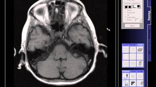 BRAIN MRI OLD INFARCTION [upl. by Idnaj]