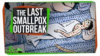 The Last Major Smallpox Outbreak in America [upl. by Kyne]