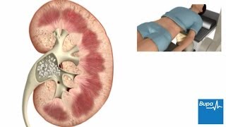 How extracorporeal shockwave lithotripsy is used to treat kidney stones  Bupa Health [upl. by Asenej517]