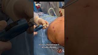 Liposuction Process by Dr Viradia lipo tampa plasticsurgery [upl. by Aivizt724]