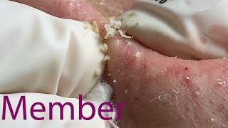 Acne Treatment Huong Da Nang 044  Member [upl. by Krein285]