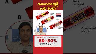 Understanding Angioplasty and Stenting Quick Guide l Dr A Ravikanth shorts MedPlusONETV [upl. by Evy]