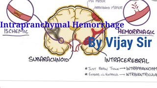 Intraparenchymal Hemorrhage by Vijay sir [upl. by Acirej136]