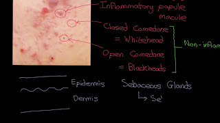 Acne Vulgaris Part 1 [upl. by Baerl]