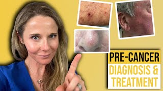 Actinic keratosis treatment guide from a Dermatologist [upl. by Immot]