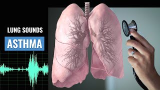 Asthma Lung sound  Wheezing  Asthma  Christina NP  Caring Casa [upl. by Narah807]