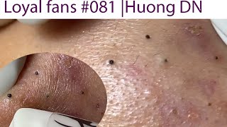 Acne Treatment Huong Da Nang 081  Loyal fans [upl. by Sholeen926]