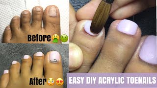 EASY DIY acrylic TOEnails😍TRENDY TOENAILS Quarantine Toenails😍 [upl. by Sauer15]