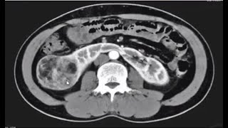 40 case of genitourinary Sportters Radiology casesradiopediafrcrexamsctmriIVPACUXrayCTUT [upl. by Ramej]