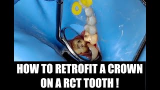 How to Retrofit a Crown After RCT with Core BuildUp and Cementation Simultaneously [upl. by Ilise]