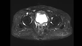 Iliopsoas bursitis [upl. by Fanny]