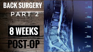 Back Surgery L4L5 Laminectomy Recovery part 2 [upl. by Alexis]