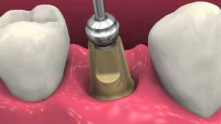 Restoring BioHorizons Dental Implants 2011 [upl. by Lightfoot219]